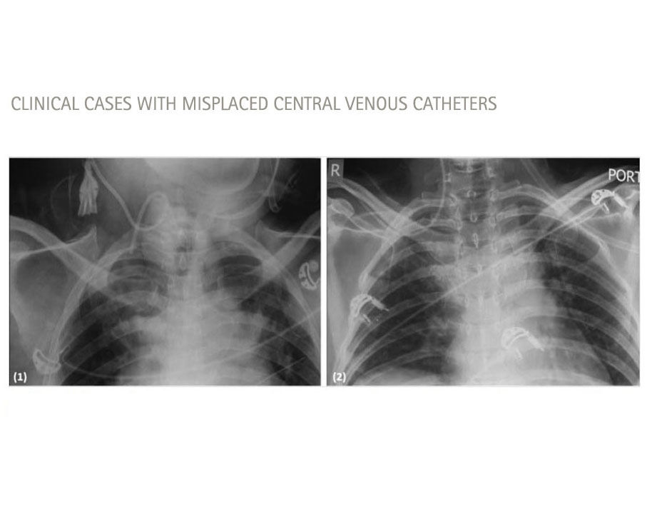 casos clínicos con CVC mal colocados