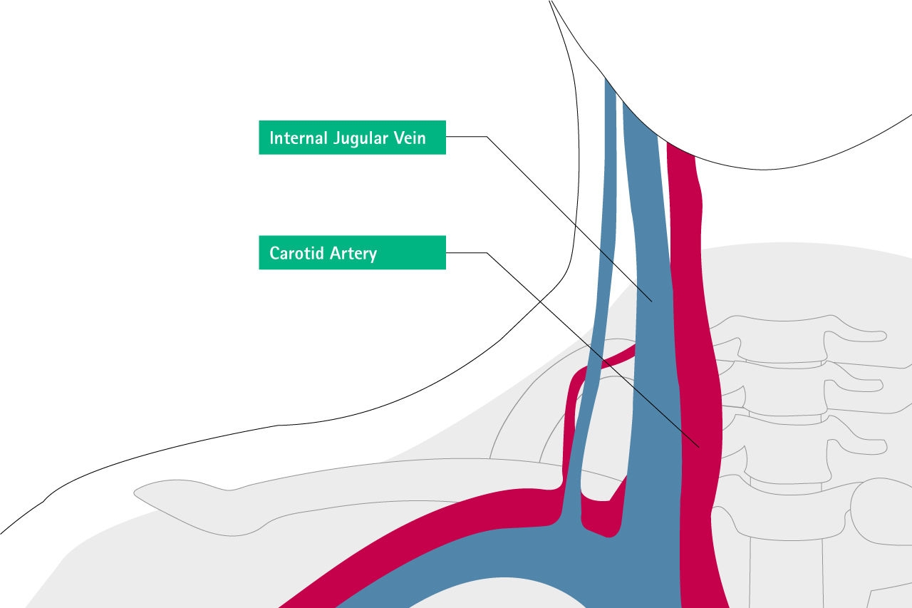 mal posicionamiento de la vena ugular interna