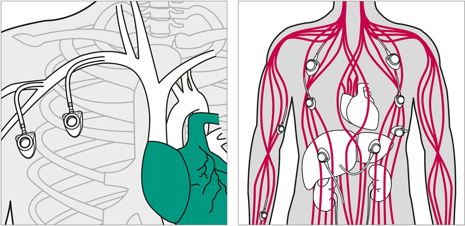 Ilustraciones de las posibles vías de acceso a un catéter de puerto vascular venoso central