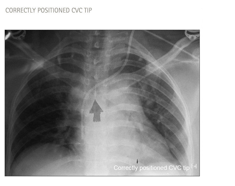 Catéter mal colocado en la radiografía