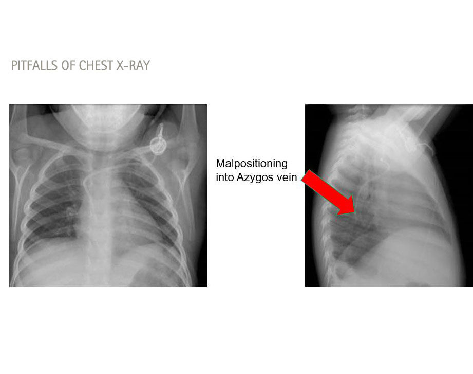 trampas de la radiografía de tórax