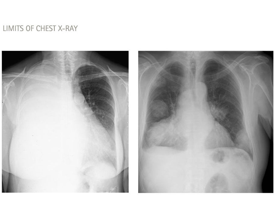 límites de la radiografía de tórax