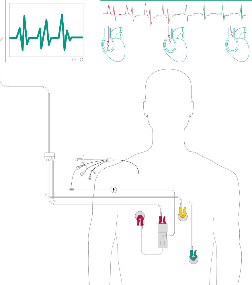 Esquema CVC