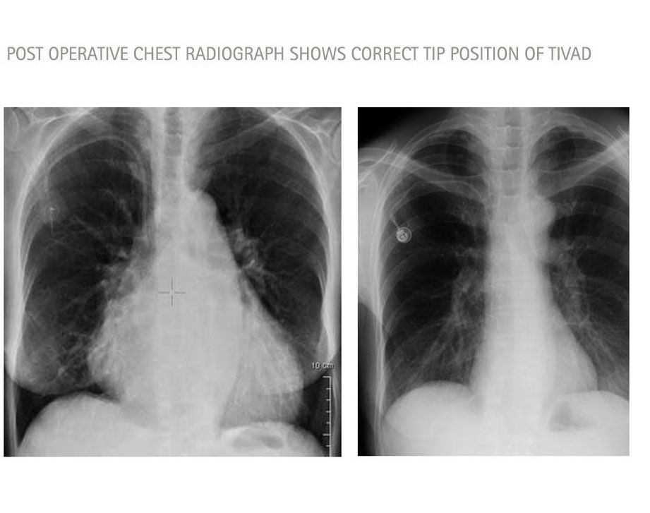 radiografía torácica posoperatoria