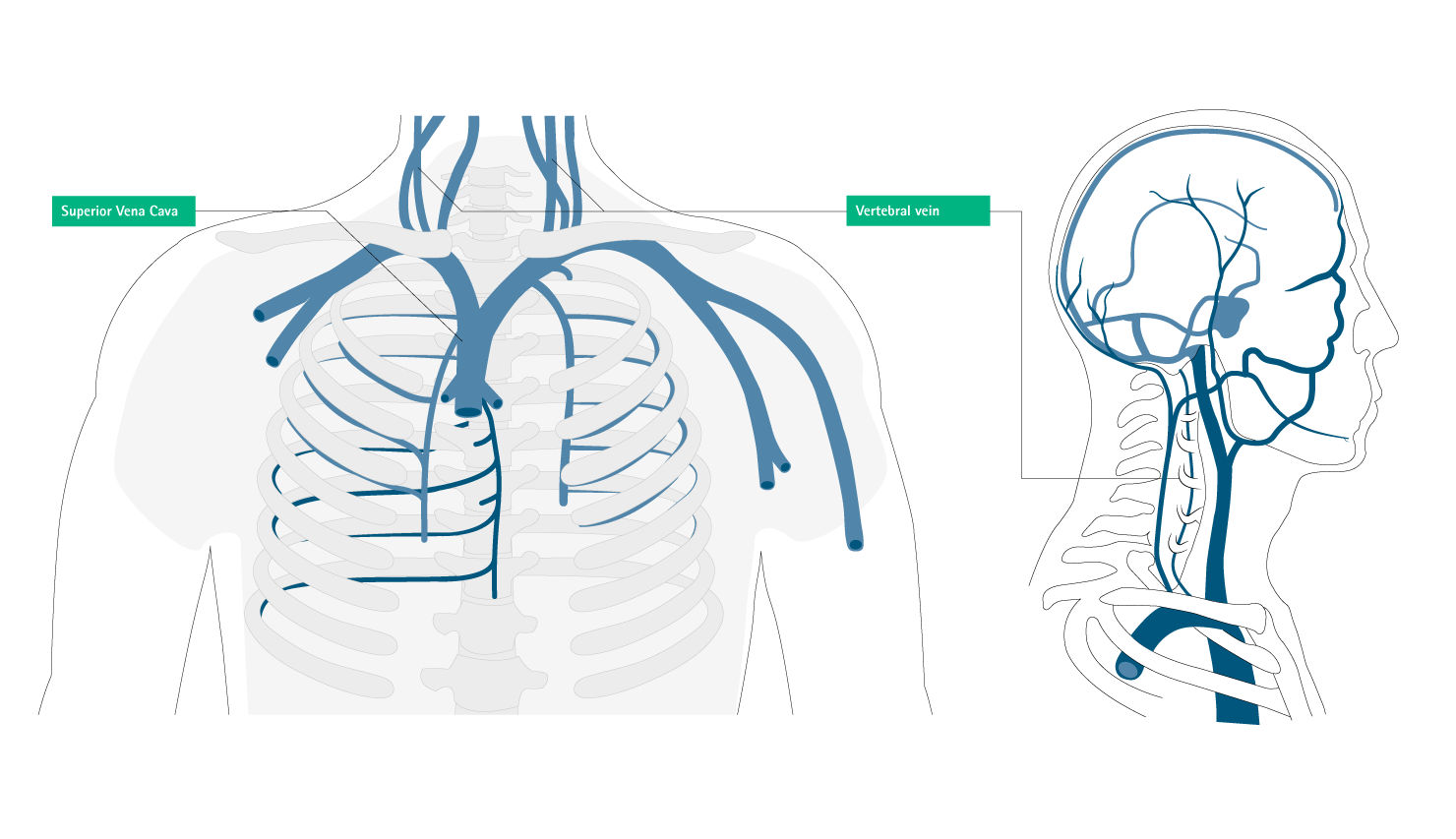 mal posicionamiento de la vena cava superior